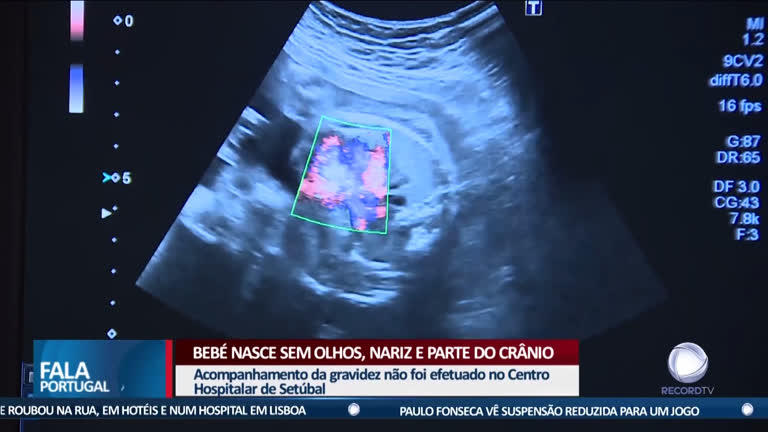 Bebe Nasce Sem Rosto Record Europa R7 Fala Portugal